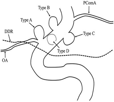 Balloon-Assisted Coils Embolization for Ophthalmic Segment Aneurysms of the Internal Carotid Artery